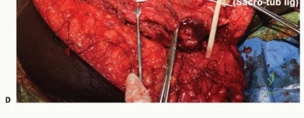 صورة طبية: ساركوما الأرداف: الحفاظ على العصب الوركي بدلاً من استئصال نصف الحوض مع الأستاذ الدكتور محمد هطيف