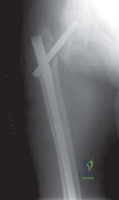 صورة توضيحية لـ استبدال مفصل الورك لإنقاذ حالات فشل تثبيت كسور الورك: حل فعال لاستعادة الحركة