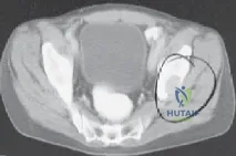 Orthopedic Board Review: Spondylolisthesis Diagnosis & Classification MCQs