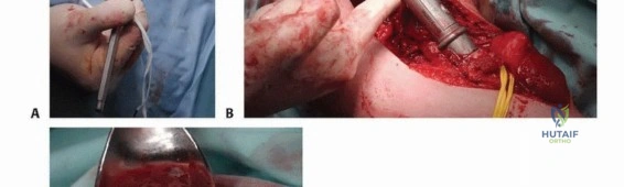 صورة طبية: جراحة نقائل عظم العضد: دليل شامل لاستعادة الوظيفة وتخفيف الألم في اليمن مع الأستاذ الدكتور محمد هطيف