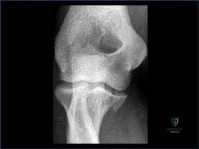 صورة طبية: دليل شامل لكسور وإصابات الجهاز الحركي: رعاية متقدمة في صنعاء مع الأستاذ الدكتور محمد هطيف