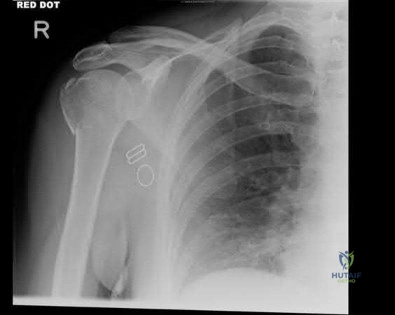 صورة طبية: دليل شامل لكسور وإصابات الجهاز الحركي: رعاية متقدمة في صنعاء مع الأستاذ الدكتور محمد هطيف
