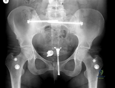 صورة طبية: دليل شامل لكسور وإصابات الجهاز الحركي: رعاية متقدمة في صنعاء مع الأستاذ الدكتور محمد هطيف