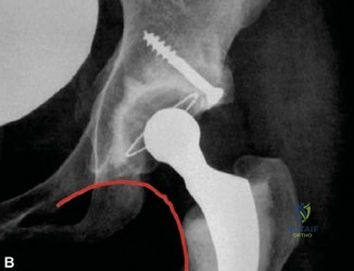 صورة طبية: تثبيت مفصل الورك بالأسمنت: دليلك الشامل لعملية ناجحة ونتائج تدوم طويلاً في صنعاء