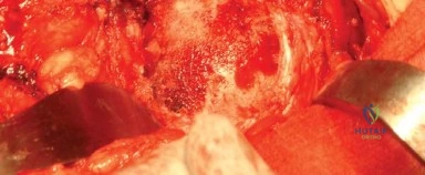 صورة طبية: المدخل الخلفي الجانبي لجراحة استبدال مفصل الورك الكلي: دليل شامل للمرضى في صنعاء مع الأستاذ الدكتور محمد هطيف