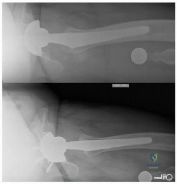 صورة طبية: إتقان مراجعة استبدال مفصل الورك: استراتيجيات تحديات الأنسجة المحلية الضارة