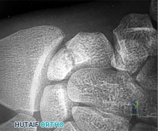 صورة طبية: دليل الأستاذ الدكتور محمد هطيف الشامل لأمراض وإصابات اليد والمعصم في صنعاء