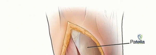 صورة طبية: قطع عظم الظنبوب العالي: إعادة محاذاة الركبة لتخفيف دائم لآلامها مع الأستاذ الدكتور محمد هطيف