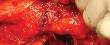 صورة طبية: المدخل الخلفي الجانبي لجراحة استبدال مفصل الورك الكلي: دليل شامل للمرضى في صنعاء مع الأستاذ الدكتور محمد هطيف