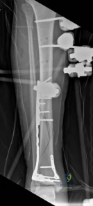 Illustration of tibial shaft fracture - Dr. Mohammed Hutaif