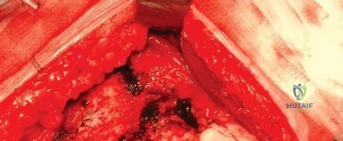 صورة طبية: النهج الخلفي الجانبي المتقدم: تحقيق أفضل النتائج في جراحة استبدال مفصل الورك الكلي مع الأستاذ الدكتور محمد هطيف في صنعاء