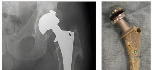 صورة توضيحية لـ إتقان مراجعة استبدال مفصل الورك: استراتيجيات تحديات الأنسجة المحلية الضارة