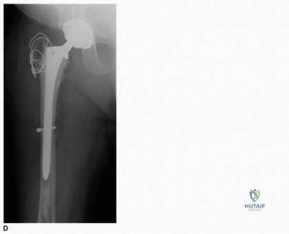 توضيح طبي: إعادة بناء الجزء العلوي من عظم الفخذ: تقنيات الطعم العظمي الاصطناعي والمفصل الداخلي مع الأستاذ الدكتور محمد هطيف في صنعاء