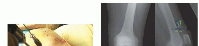 صورة طبية: قطع عظم الظنبوب العالي: إعادة محاذاة الركبة لتخفيف دائم لآلامها مع الأستاذ الدكتور محمد هطيف