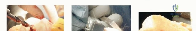 صورة طبية: جراحة استبدال مفصل الركبة الكلي بالأسمنت: حل دائم لتخفيف الألم واستعادة الحركة مع الأستاذ الدكتور محمد هطيف في صنعاء