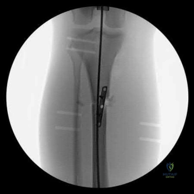 صورة طبية: دليل شامل لكسور وإصابات الجهاز الحركي: رعاية متقدمة في صنعاء مع الأستاذ الدكتور محمد هطيف