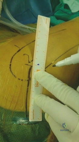 الأعراض السريرية لمشاكل مفصل الورك