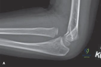 Pediatric Fracture Cases: Clinical Presentation, Exam, & Imaging Insights