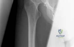 صورة توضيحية لـ قطع العظم حول الحقي بيرنيز: حل دائم لخلل التنسج الوركي واستعادة جودة الحياة
