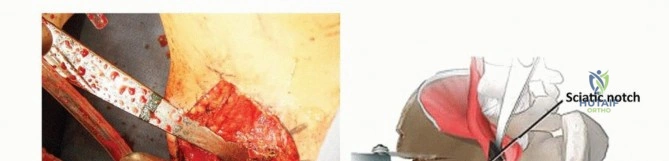 صورة طبية: استعادة صحة مفصل الفخذ جراحة قطع العظم الحوضي لعلاج خلل التنسج الحُقّي في صنعاء