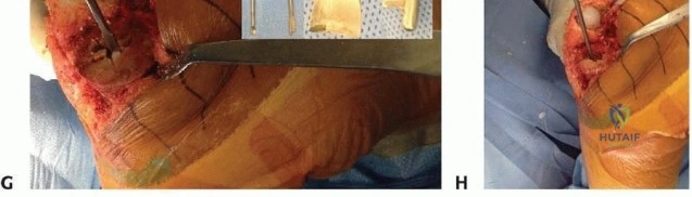 صورة طبية: جراحة مراجعة مفصل الركبة: تقنيات آمنة لإزالة المكونات الثابتة واستعادة الحركة مع الأستاذ الدكتور محمد هطيف في صنعاء