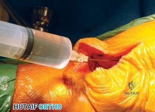 ارتداء الجوارب الضاغطة للوقاية من الجلطات