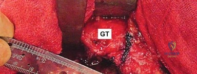 صورة توضيحية لـ إتقان توازن الأنسجة الرخوة لمفصل ورك صناعي مثالي: دليل شامل للمرضى مع الأستاذ الدكتور محمد هطيف