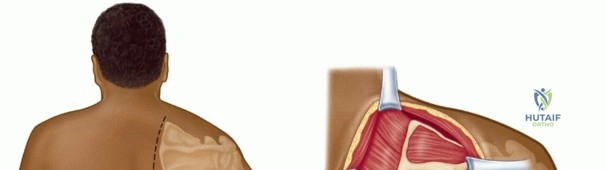صورة طبية: متلازمة لوح الكتف الطقطقة الأسباب الأعراض والعلاج مع الأستاذ الدكتور محمد هطيف