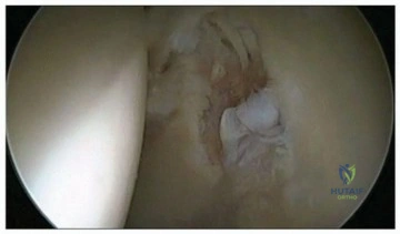 نسبة نجاح عملية استبدال مفصل الورك تتراوح بين 95% إلى 97%