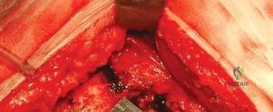 صورة طبية: المدخل الخلفي الجانبي لجراحة استبدال مفصل الورك الكلي: دليل شامل للمرضى في صنعاء مع الأستاذ الدكتور محمد هطيف