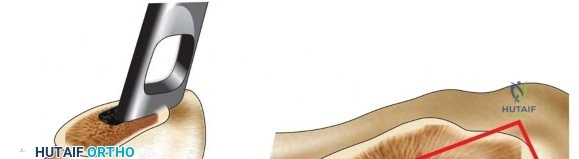 تقييم أعراض الورك