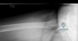 صورة توضيحية لـ جراحة استبدال مفصل الورك الهجين لكسور عنق الفخذ المتبدلة دليل شامل للمرضى مع الأستاذ الدكتور محمد هطيف