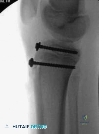 Illustration of exits from the physis - Dr. Mohammed Hutaif