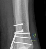 Illustration of partial articular fractureplate - Dr. Mohammed Hutaif