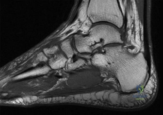 Illustration of figure mri sagittal - Dr. Mohammed Hutaif