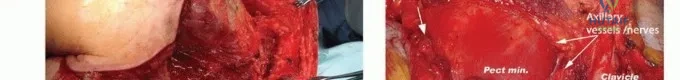 تأثير العلاج الإشعاعي على الأنسجة