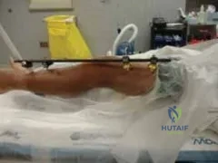 تفاصيل مرئية 59 - التثبيت الخارجي للقصبة: هكذا يتم وضع مسمارين لكسور معقدة