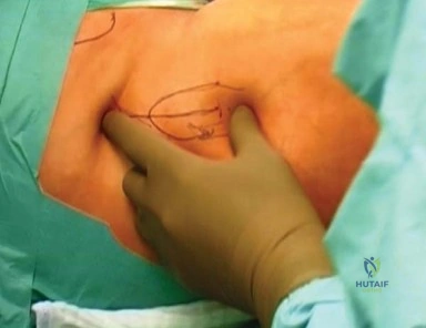 صورة توضيحية لـ النهج الأمامي الجانبي في استبدال مفصل الورك بالتدخل المحدود: دليل شامل للمرضى مع الأستاذ الدكتور محمد هطيف
