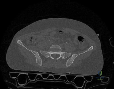صورة طبية: دليل شامل لكسور وإصابات الجهاز الحركي: رعاية متقدمة في صنعاء مع الأستاذ الدكتور محمد هطيف