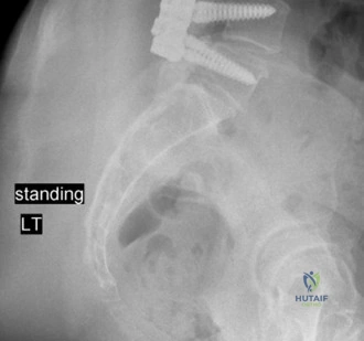Illustration of adjacent segment degeneration - Dr. Mohammed Hutaif