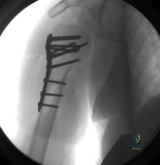 صورة طبية: دليل شامل لكسور وإصابات الجهاز الحركي: رعاية متقدمة في صنعاء مع الأستاذ الدكتور محمد هطيف