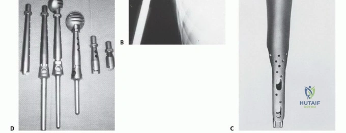 صورة توضيحية لـ استئصال الجزء القريب من عظم العضد بتقنيات الحفاظ على الطرف: دليل شامل للمرضى مع الأستاذ الدكتور محمد هطيف