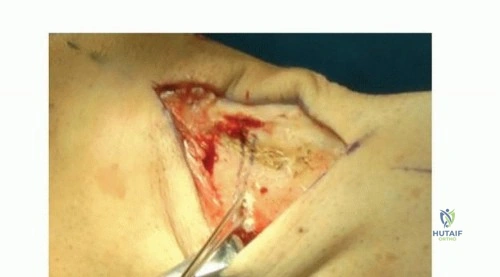 صورة طبية: قطع عظم الظنبوب العالي: إعادة محاذاة الركبة لتخفيف دائم لآلامها مع الأستاذ الدكتور محمد هطيف