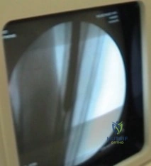 صورة طبية: تثبيت مفصل الركبة بالمسمار النخاعي: حل فعال لمشاكل المفاصل الصناعية الفاشلة