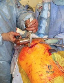 صورة طبية: استبدال مفصل الورك الكلي في العيادات الخارجية: دليل شامل من الأستاذ الدكتور محمد هطيف في صنعاء