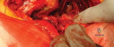 صورة توضيحية لـ المدخل الخلفي الجانبي لجراحة استبدال مفصل الورك الكلي: دليل شامل للمرضى في صنعاء مع الأستاذ الدكتور محمد هطيف
