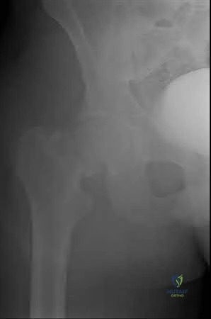 صورة طبية: دليل شامل لكسور وإصابات الجهاز الحركي: رعاية متقدمة في صنعاء مع الأستاذ الدكتور محمد هطيف