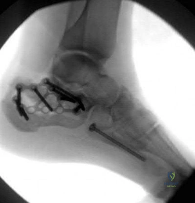 صورة طبية: دليل شامل لكسور وإصابات الجهاز الحركي: رعاية متقدمة في صنعاء مع الأستاذ الدكتور محمد هطيف