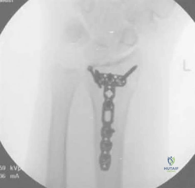 صورة طبية: دليل شامل لكسور وإصابات الجهاز الحركي: رعاية متقدمة في صنعاء مع الأستاذ الدكتور محمد هطيف