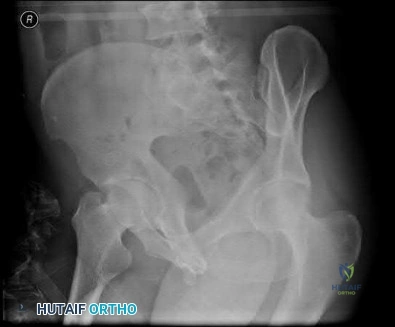صورة طبية: دليل شامل لكسور وإصابات الجهاز الحركي: رعاية متقدمة في صنعاء مع الأستاذ الدكتور محمد هطيف